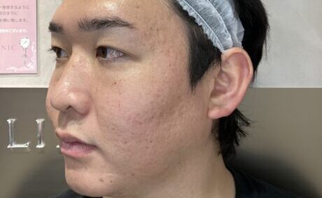 After