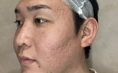 Before